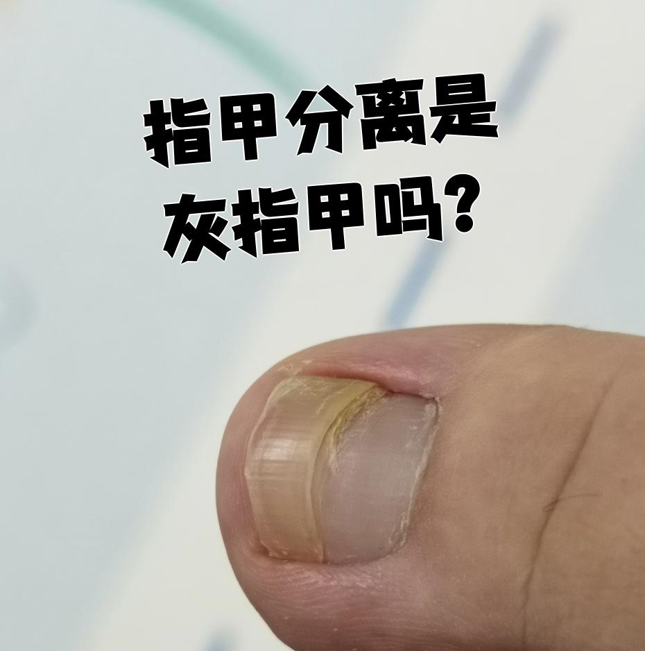 指甲分离症的图片(指甲分离症的图片对比) 指甲分离症的图片(指甲分离症的图片对比)