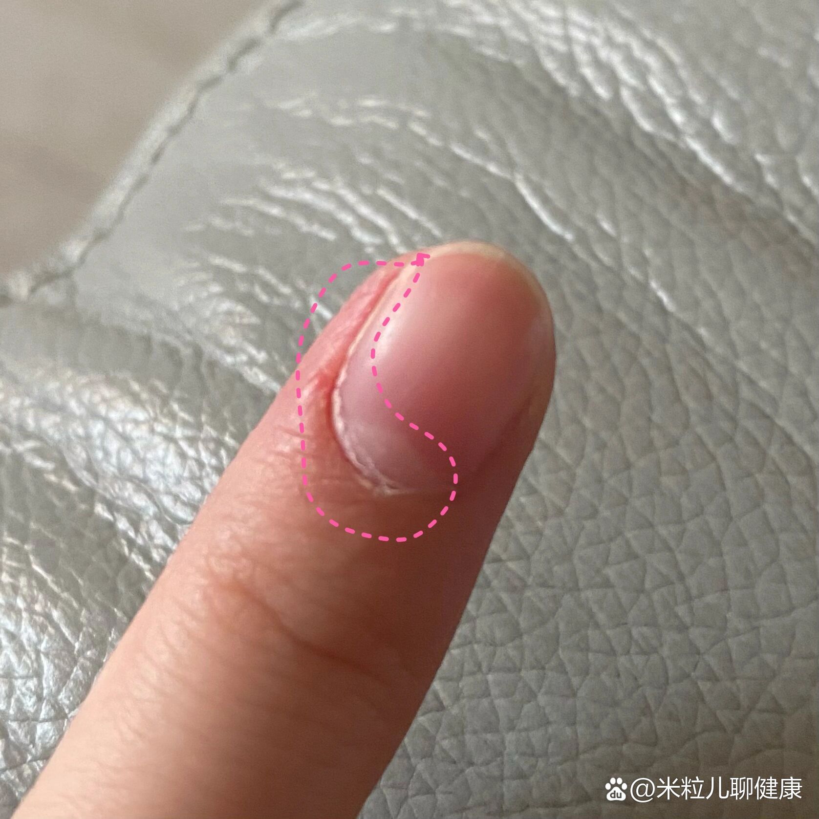 手指甲盖和肉分离图片的简单介绍 手指甲盖和肉分离图片的简单介绍