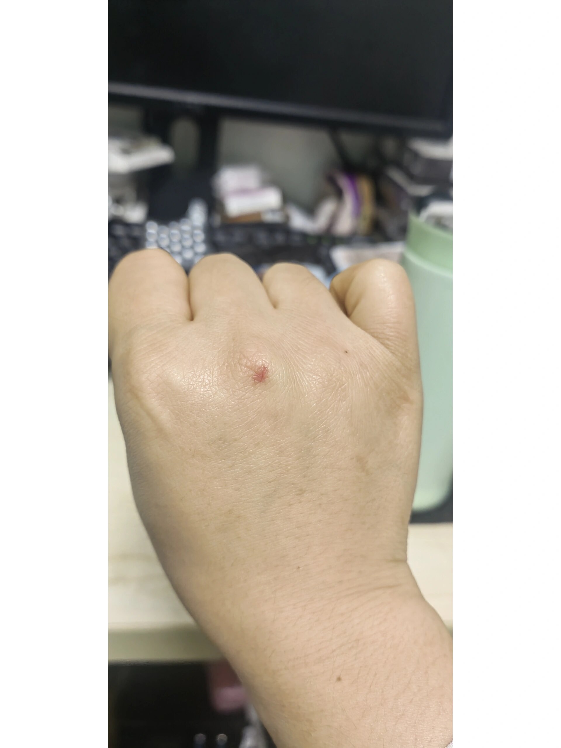 艾滋病手背红疹图片(hpv感染红疹子图片)