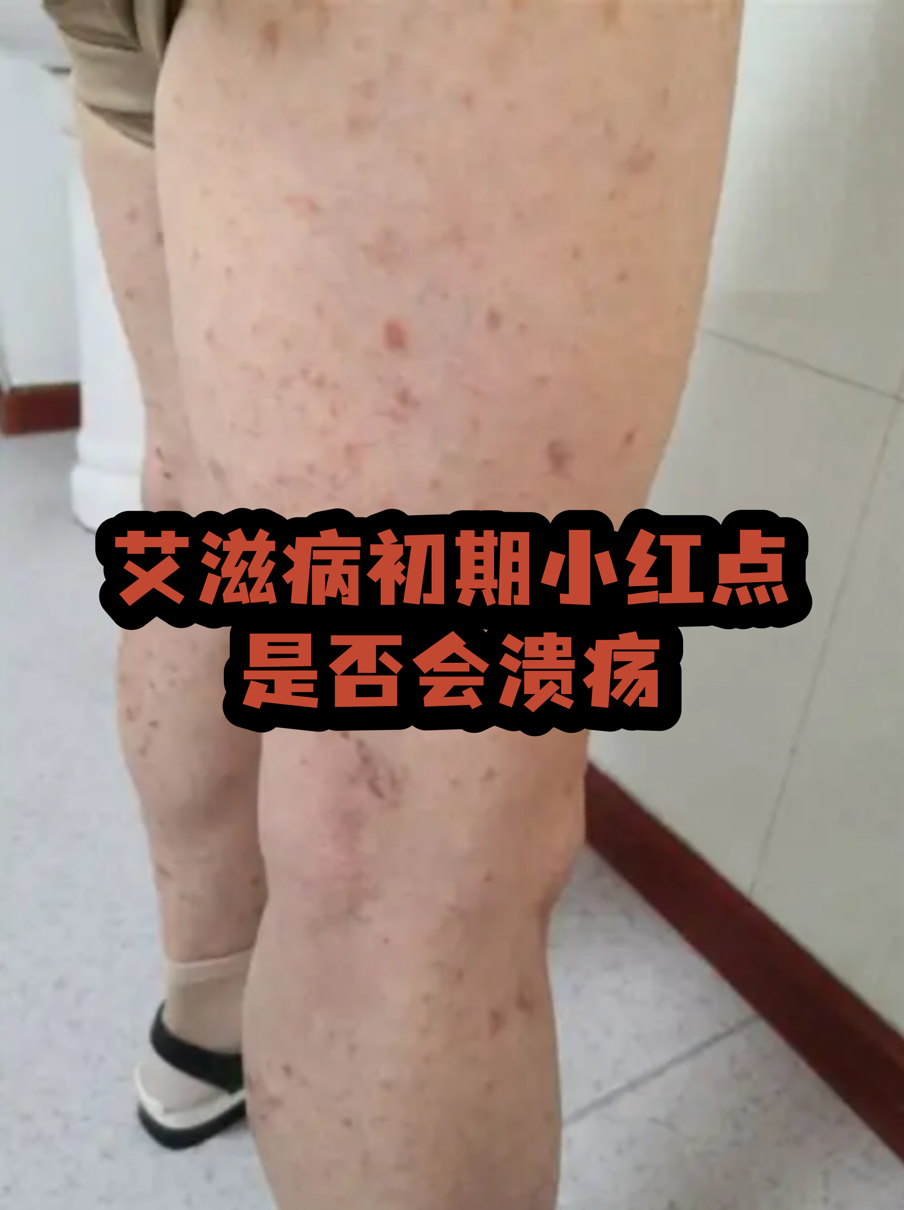 艾滋病手背红疹图片(hpv感染红疹子图片) 艾滋病手背红疹图片(hpv感染红疹子图片)