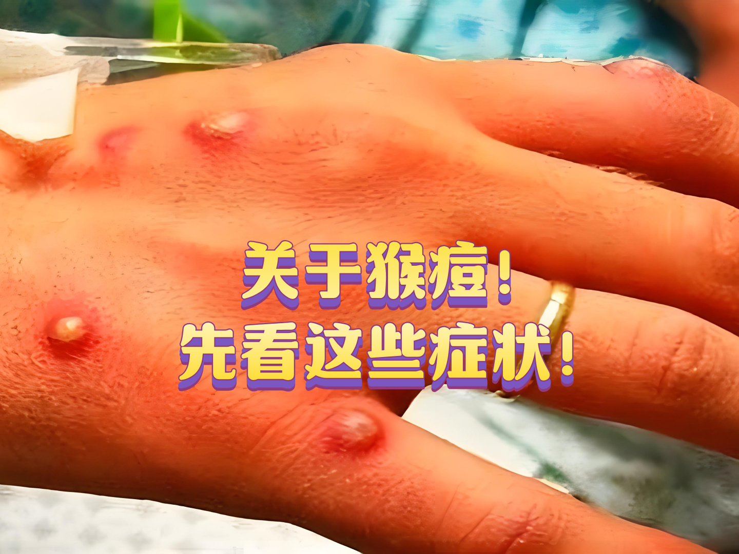 重庆现猴痘病例吴尊友发文回应的简单介绍