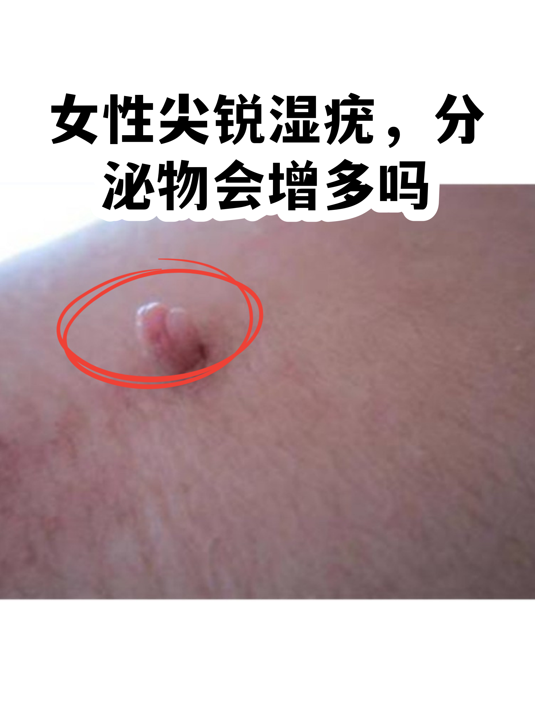 关于hpv是什么病女性表现是什么样图片的信息 关于hpv是什么病女性表现是什么样图片的信息