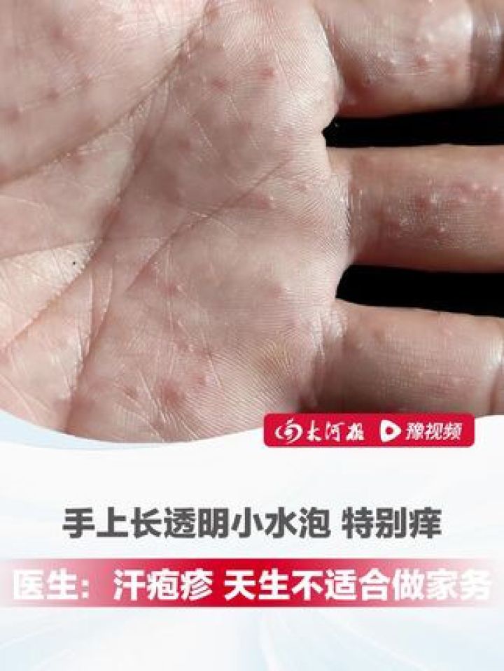 水泡型疱疹图片(腰部水泡型疱疹图片)