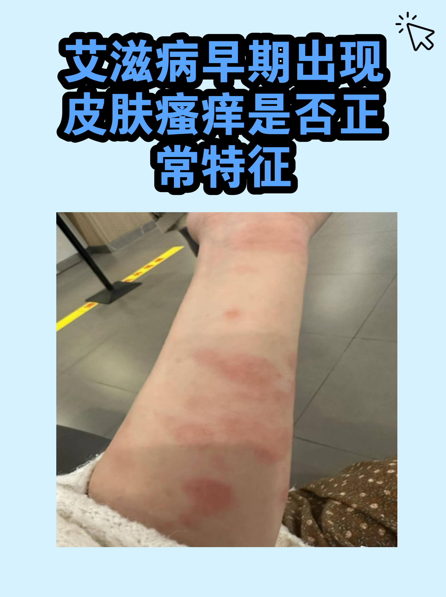 艾滋病皮肤前兆图片(艾滋病皮肤早期症状图片)