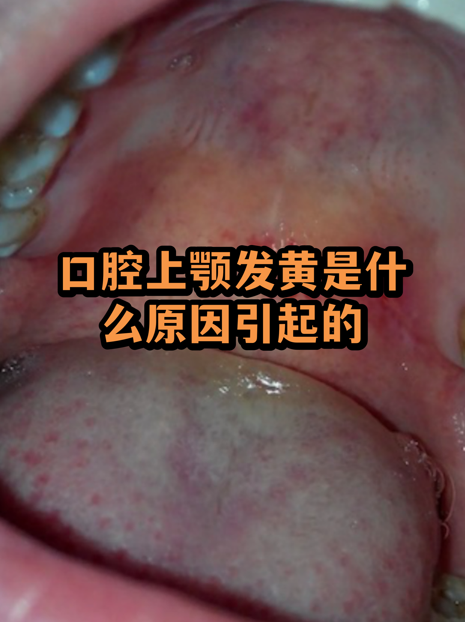 上颚图片(手足口病上颚图片)