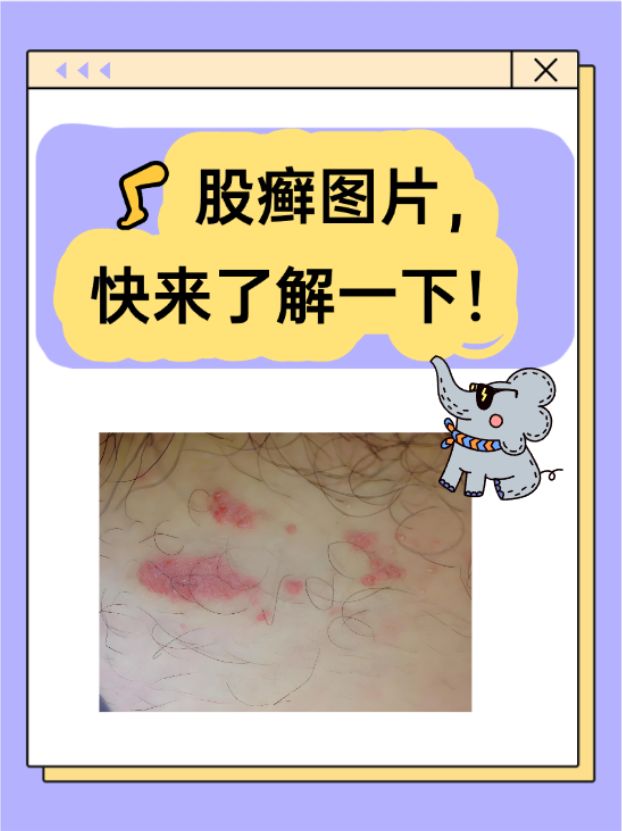 金钱癣图片(金钱癣用什么药膏) 金钱癣图片(金钱癣用什么药膏)