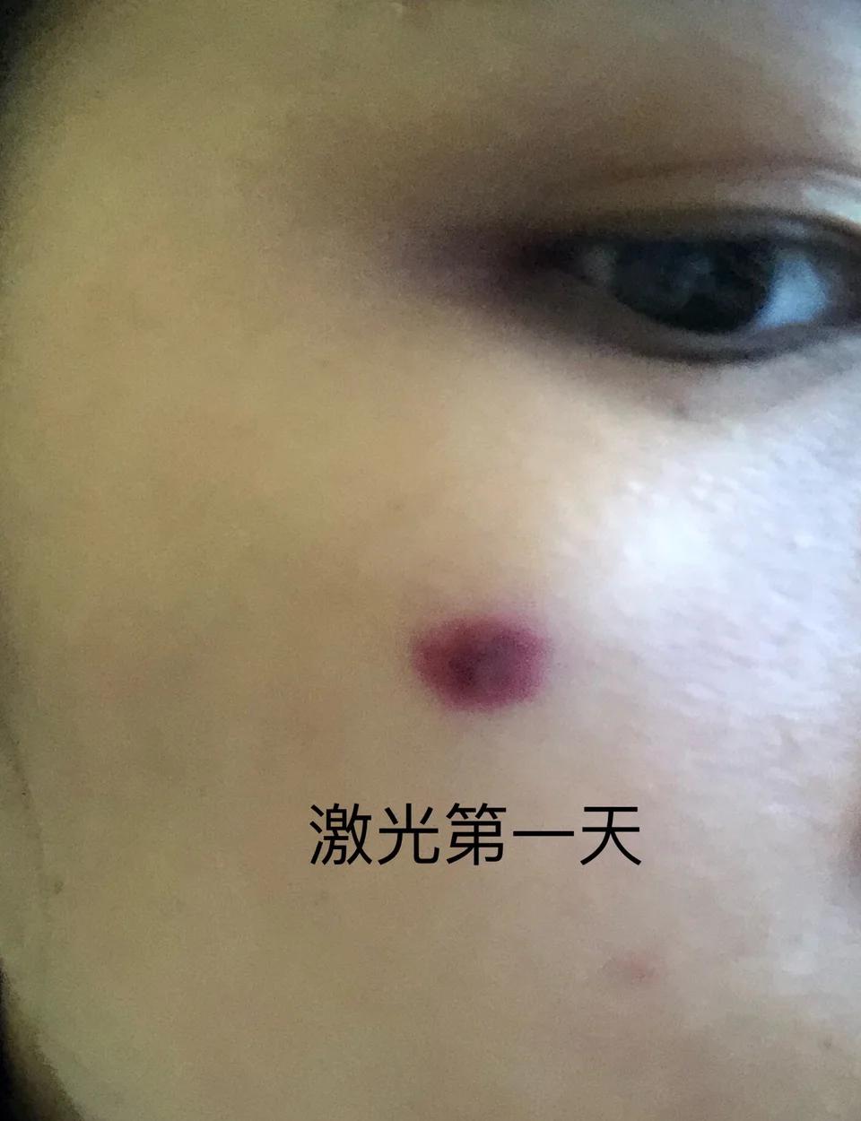 蜘蛛痣的超清图片(蜘蛛痣的超清图片高清) 蜘蛛痣的超清图片(蜘蛛痣的超清图片高清)