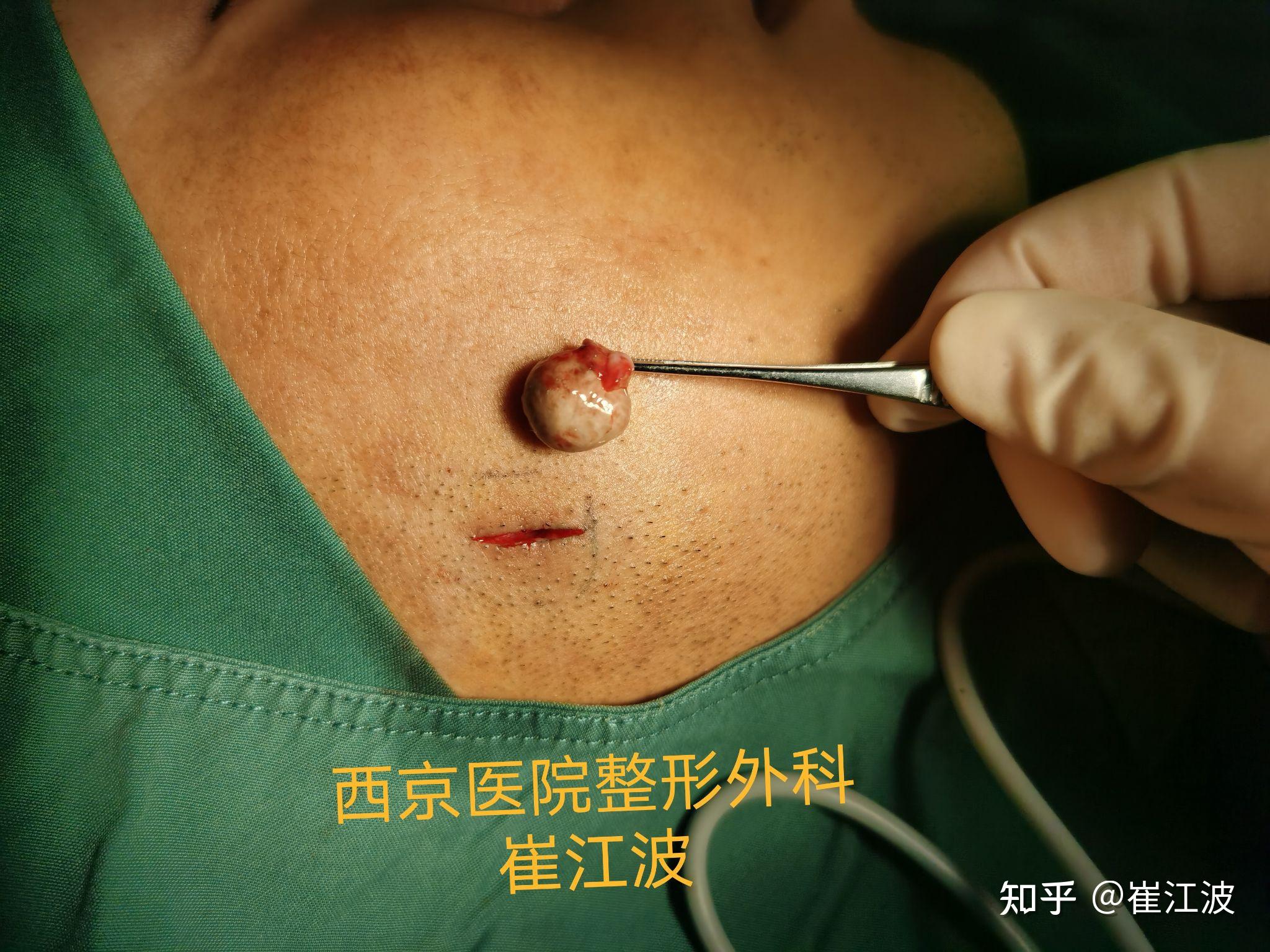 粉瘤是什么样子的图片(粉瘤长什么样图片 早期)