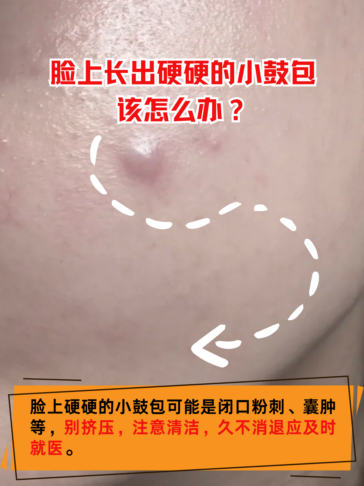 粉瘤是什么样子的图片(粉瘤长什么样图片 早期)