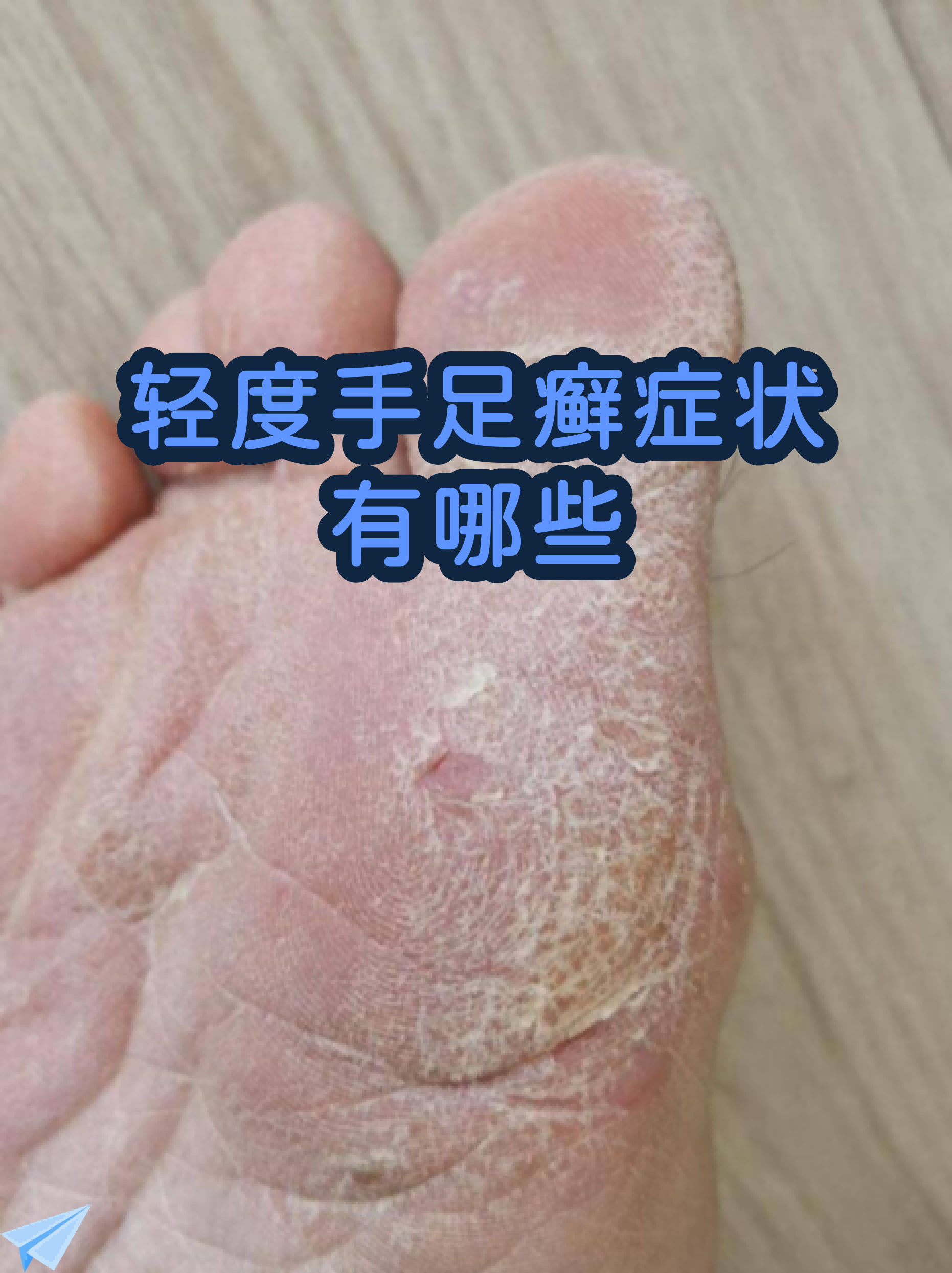 香港脚图片(香港脚图片 症状)