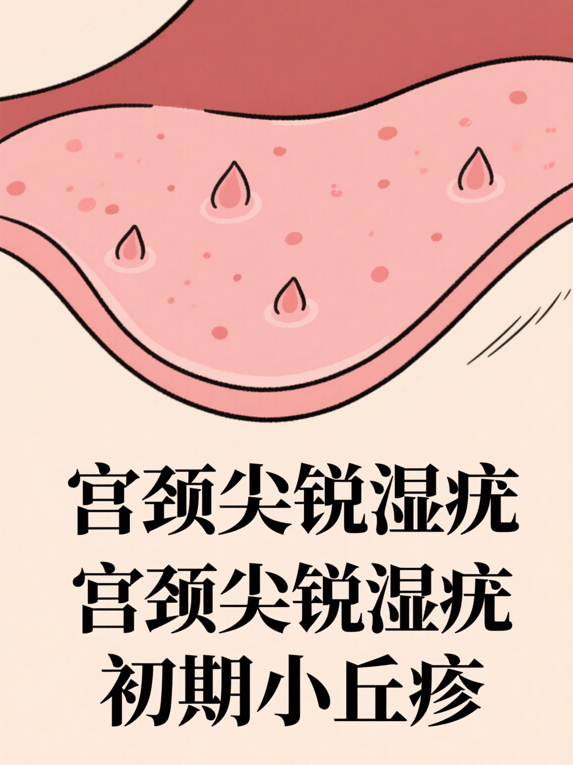 湿锐尤早期图片(湿锐尤是什么引起的) 湿锐尤早期图片(湿锐尤是什么引起的)