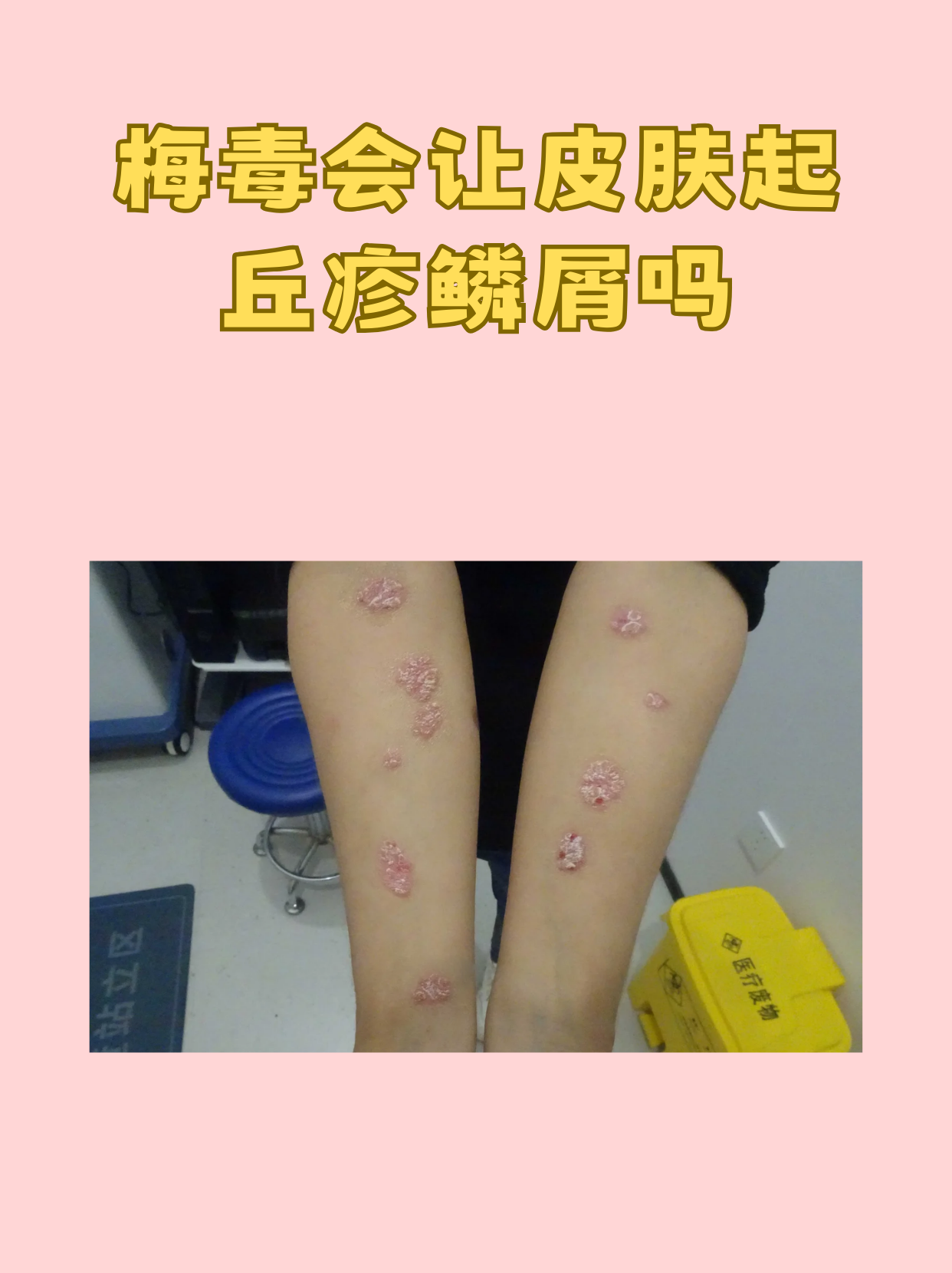 梅毒疹图片大全(梅毒疹图片大全 初期) 梅毒疹图片大全(梅毒疹图片大全 初期)