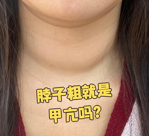 女性甲亢早期脖子图片(女性甲亢早期脖子图片 正常)
