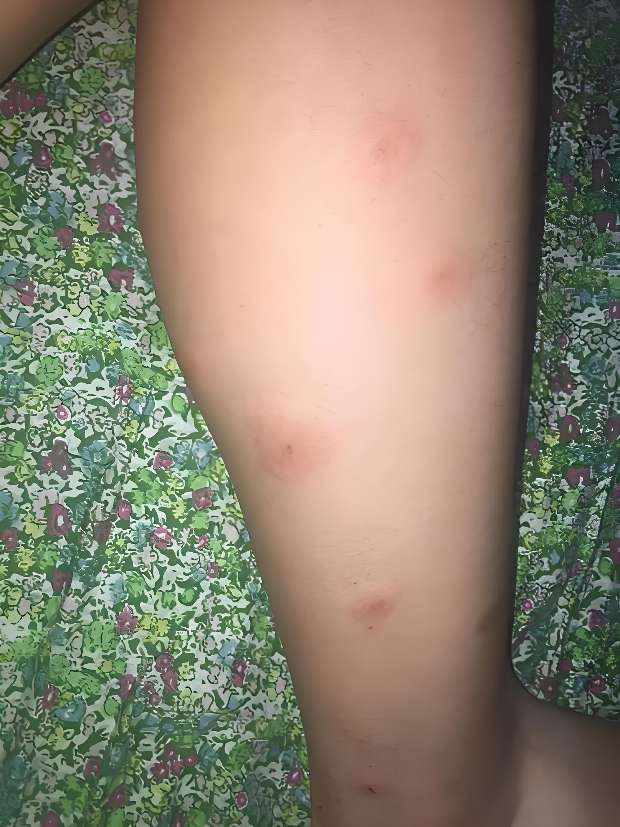 被臭虫咬的症状图片(被臭虫咬的症状图片 后期)