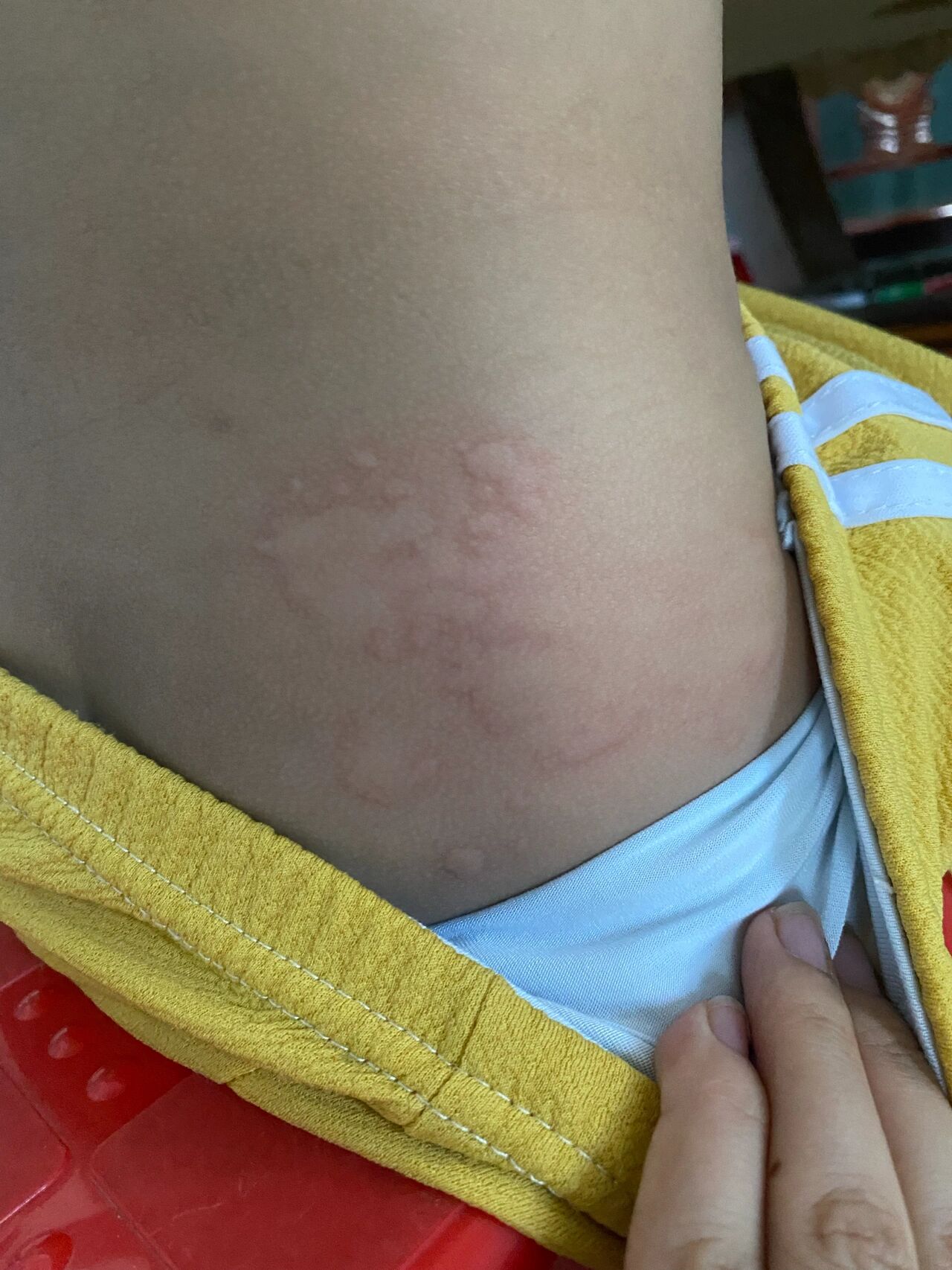 小儿荨麻疹照片(小儿荨麻疹图片和症状图片) 小儿荨麻疹照片(小儿荨麻疹图片和症状图片)