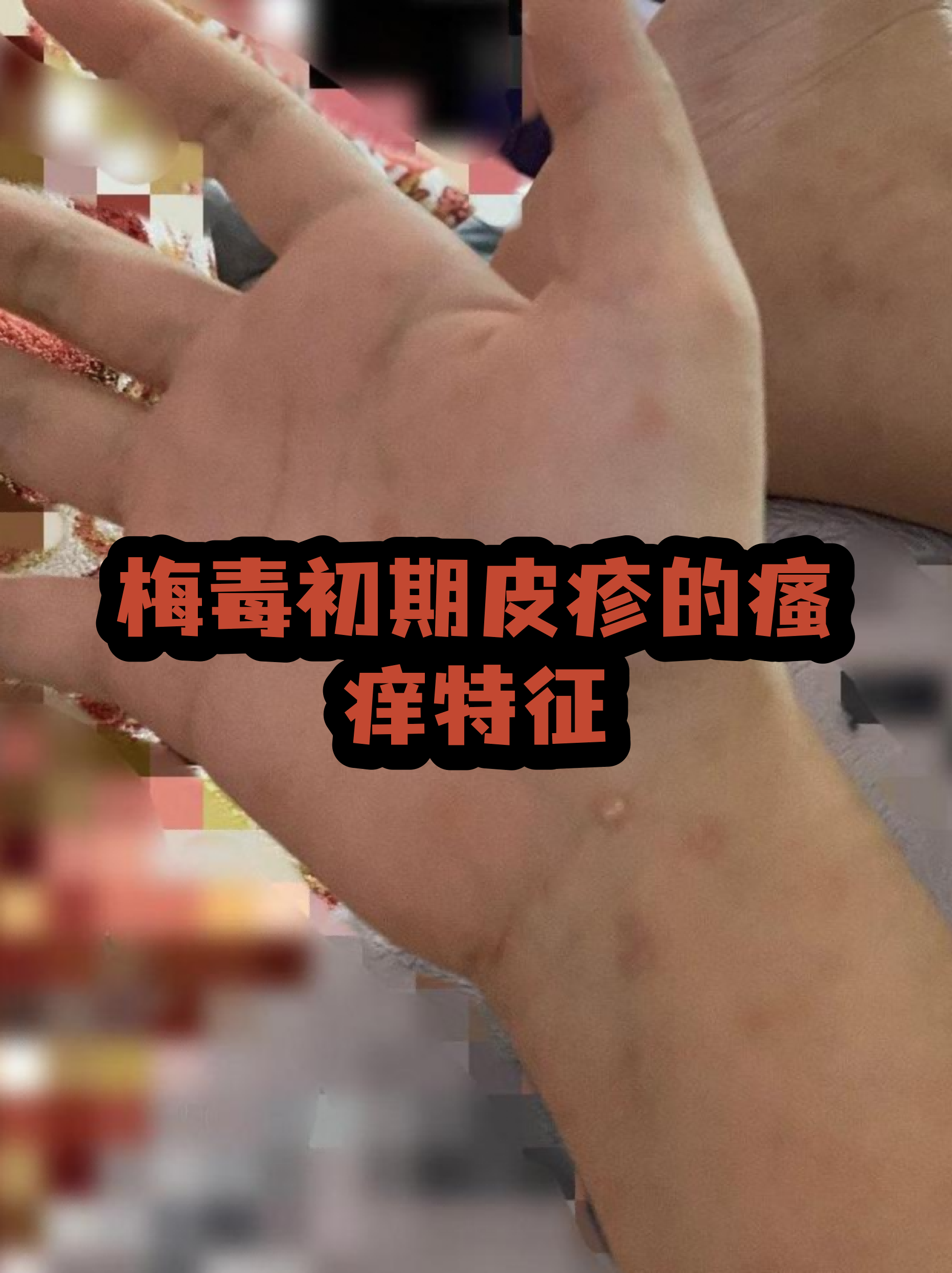 梅毒早期皮肤症状图片(梅毒初期症状皮疹图片有异味马)
