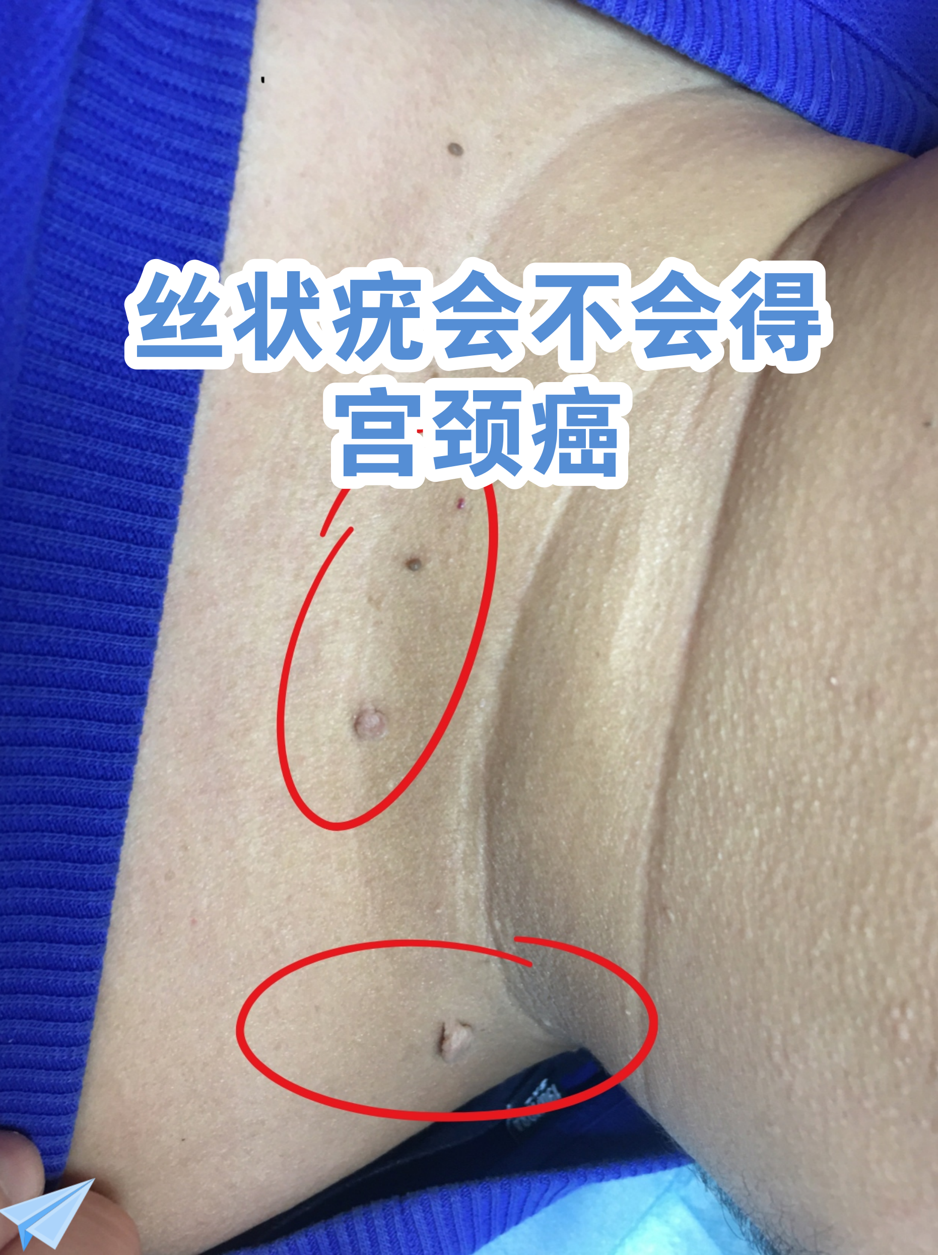 hpv疣体是什么样子图片(hpv疣体是什么样子图片女)