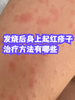 病毒疹图片(病毒疹图片和症状图片) 病毒疹图片(病毒疹图片和症状图片)