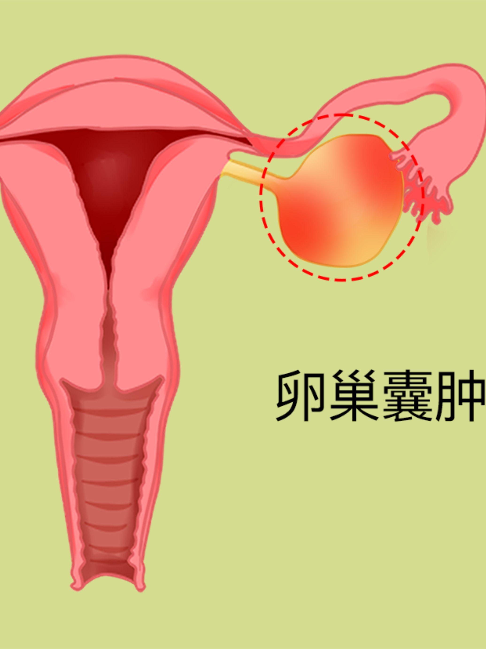 囊肿妇科图片(囊肿妇科图片高清)