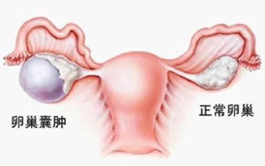 囊肿妇科图片(囊肿妇科图片高清) 囊肿妇科图片(囊肿妇科图片高清)
