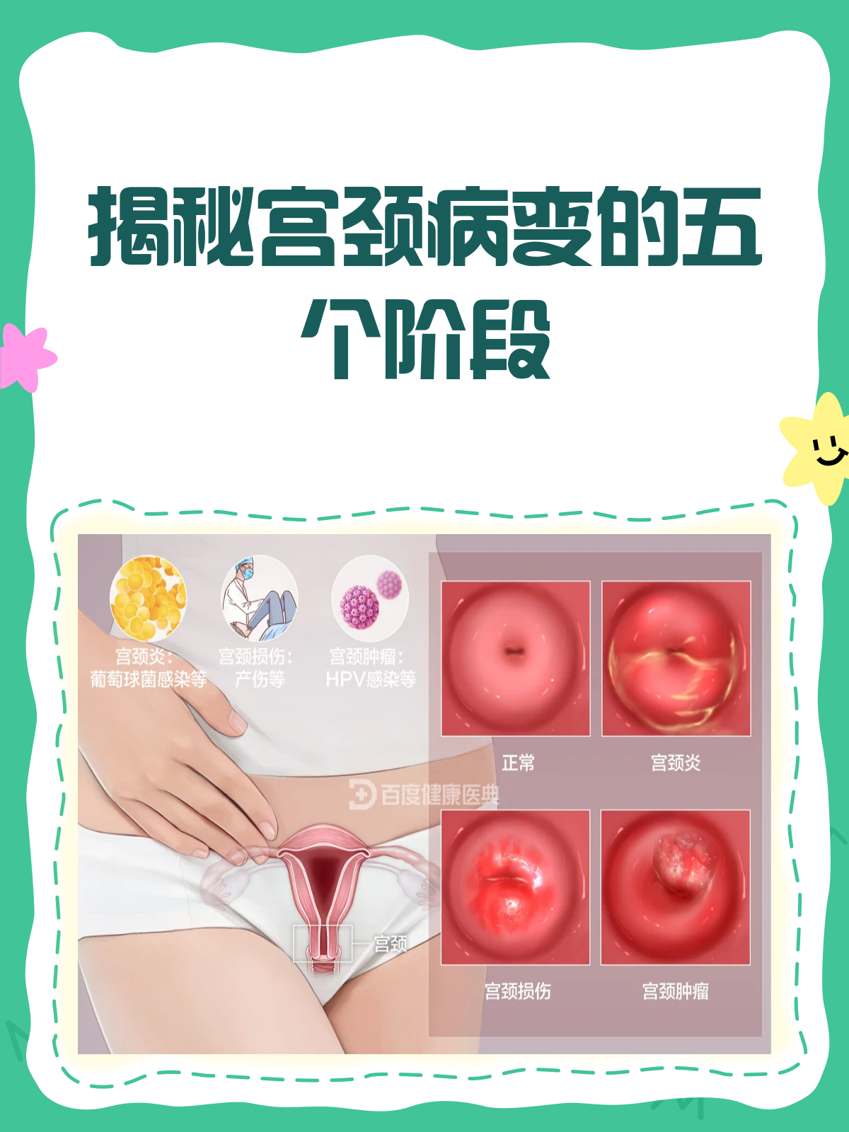 正常宫颈图片是什么样(正常宫颈图片高清 下垂)