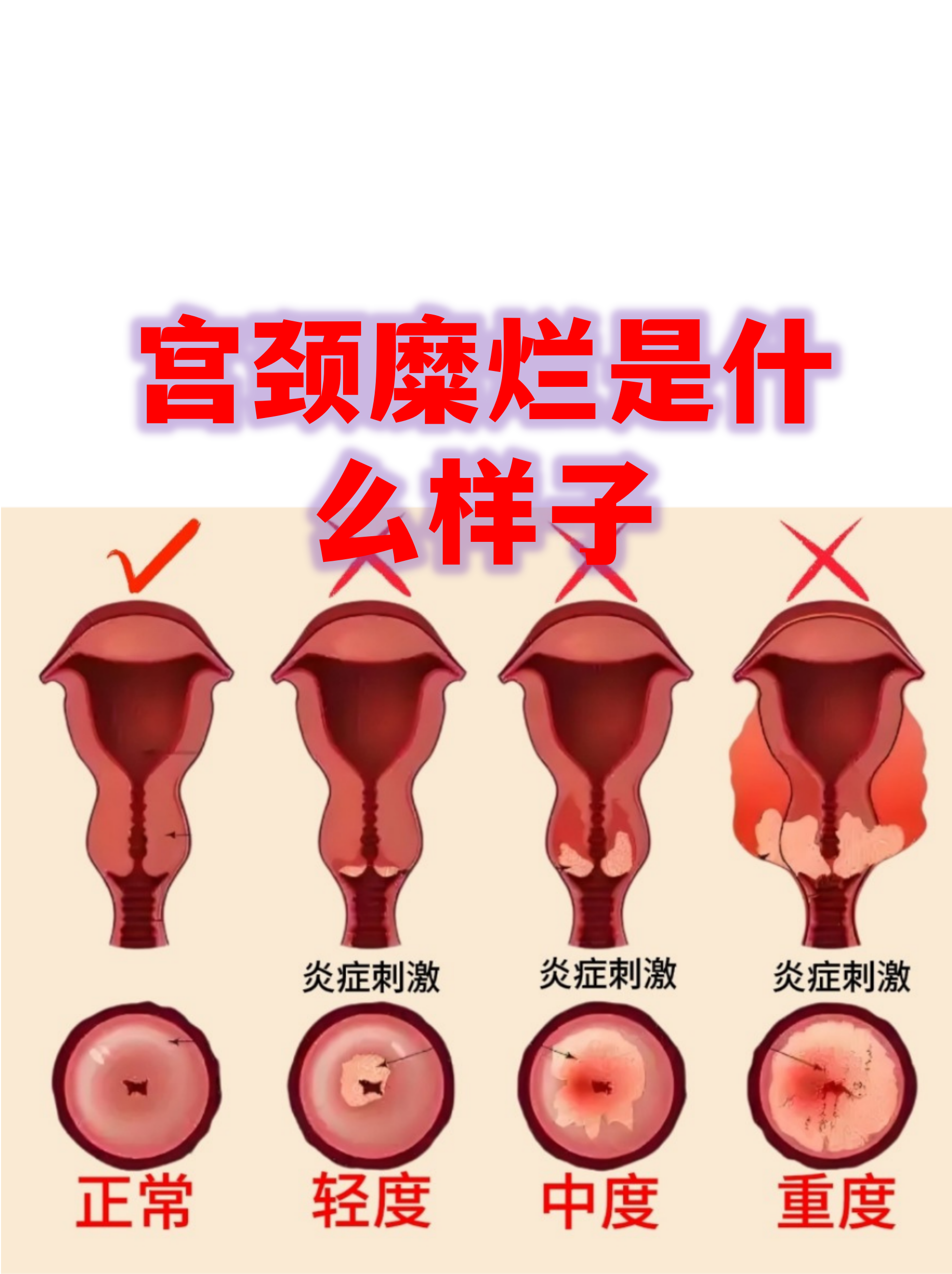 正常宫颈图片是什么样(正常宫颈图片高清 下垂)