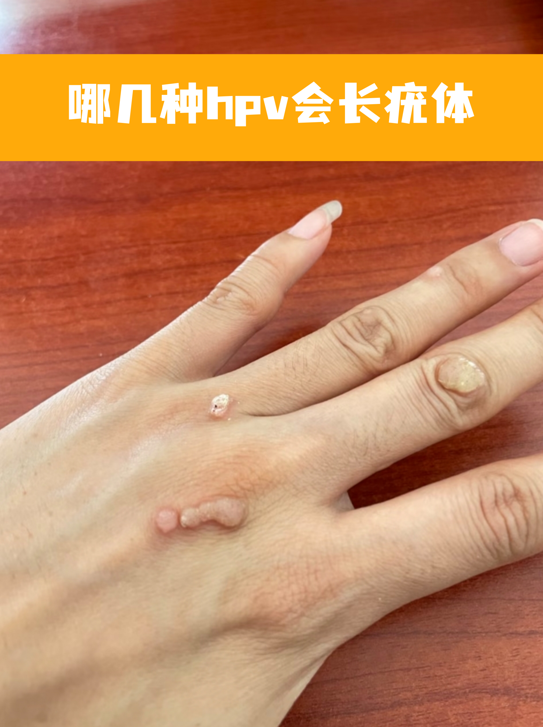 女性菜花状疣图片(尖锐湿疣的症状和图片) 女性菜花状疣图片(尖锐湿疣的症状和图片)