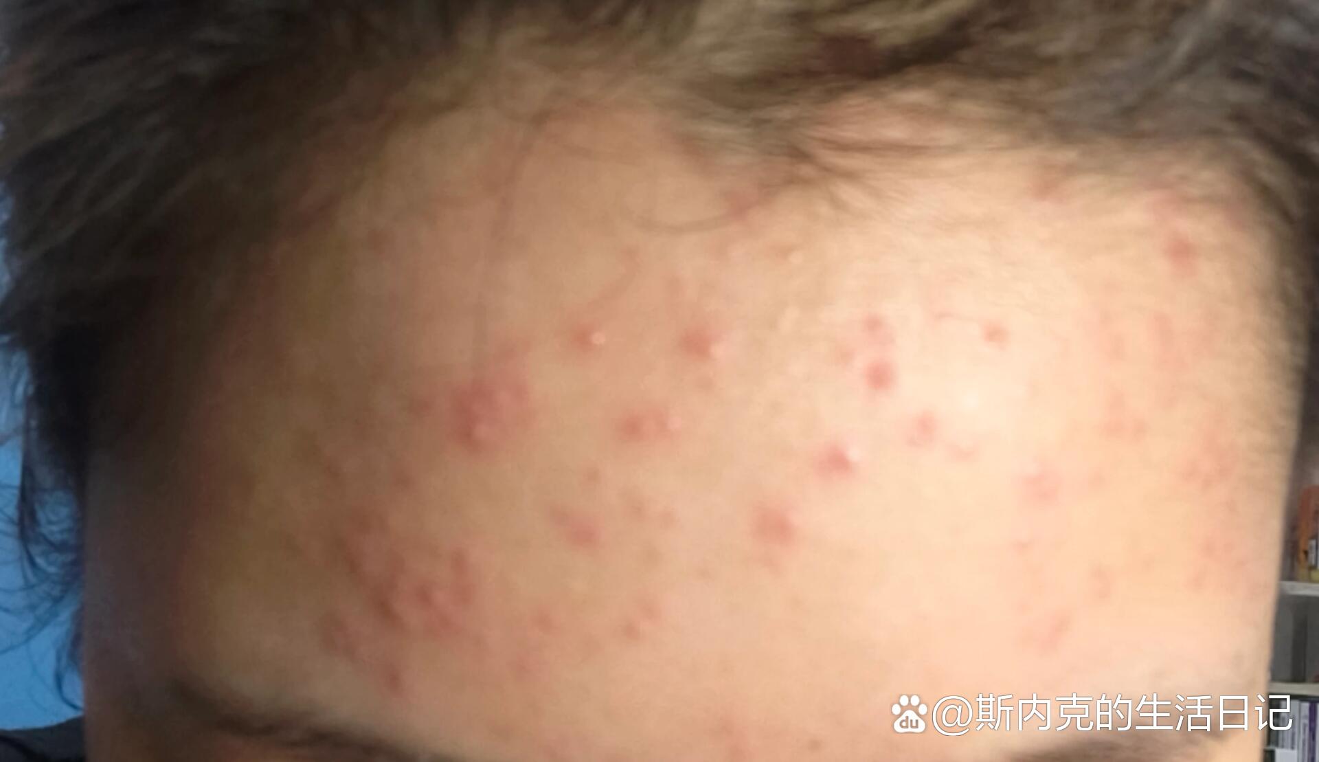 脸上长荨麻疹的图片(脸上长荨麻疹的图片大全) 脸上长荨麻疹的图片(脸上长荨麻疹的图片大全)