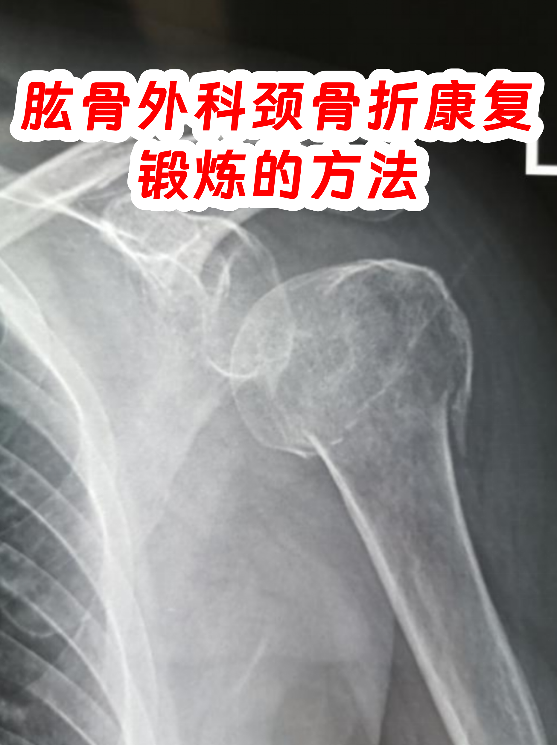 肱骨外科颈骨折图片(肱骨外科颈骨折的临床表现) 肱骨外科颈骨折图片(肱骨外科颈骨折的临床表现)