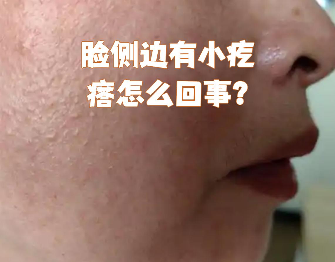 毛周角化症图片脸部两侧(毛周角化是什么图片 脸上)