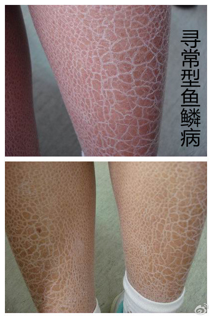 糙皮病症状图片(糙皮病的临床表现) 糙皮病症状图片(糙皮病的临床表现)