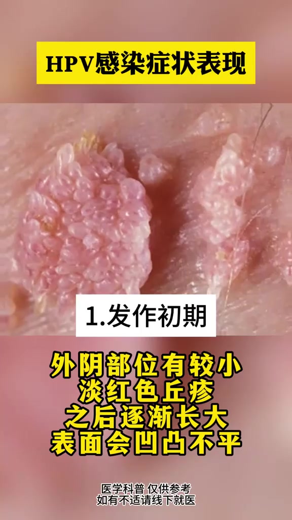 hpv图片症状图片大全(hpv图片症状图片大全女性)