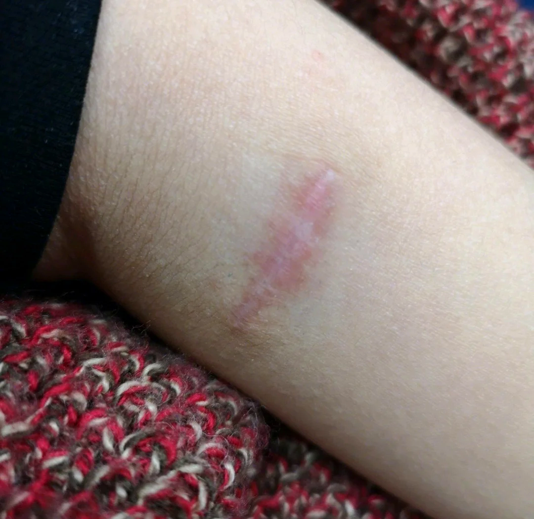 侧切疤痕真实图片慎入删除的简单介绍