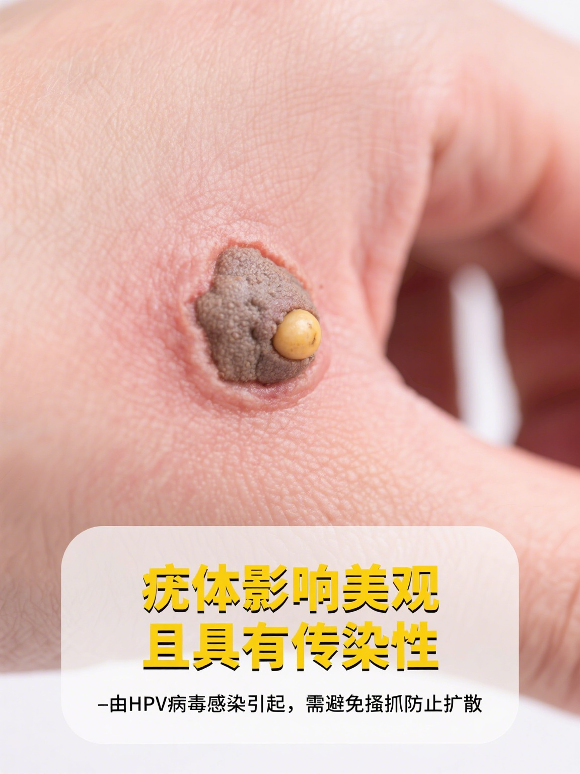 hpv长疣体什么样子的图片(hpv长疣体了是恶变的意思吗)