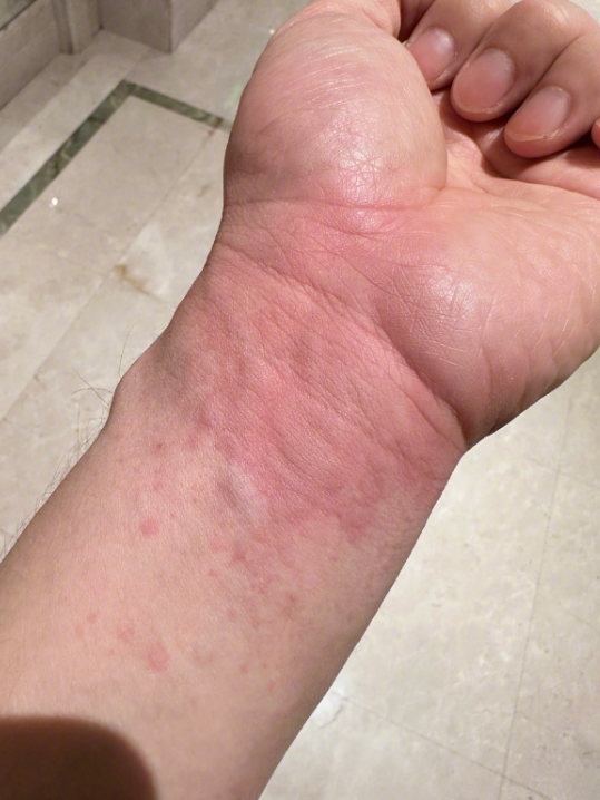 尿毒症早期症状图片(尿毒症的早期症状有哪些女性)