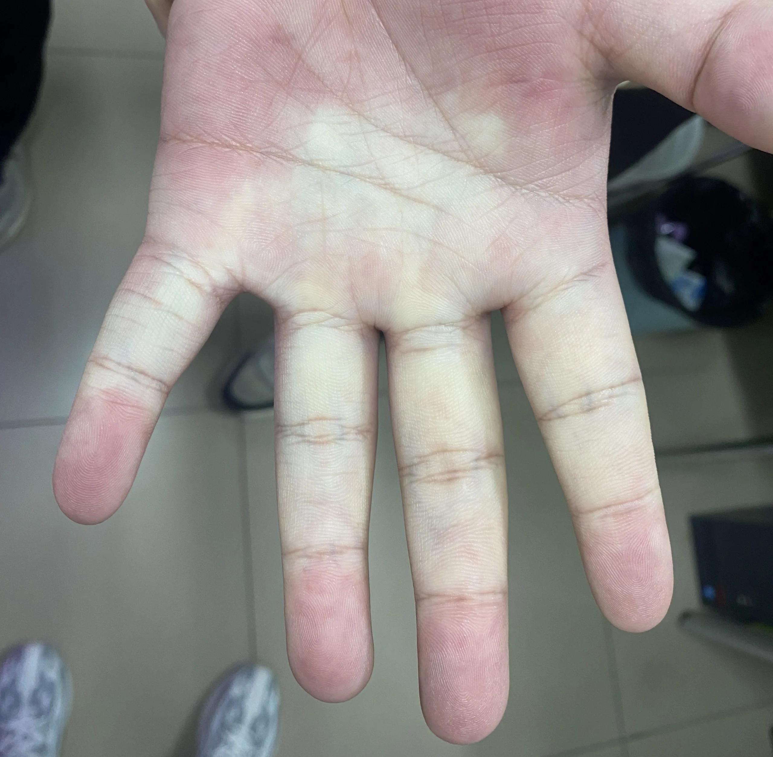 糙皮病初期图片(糙皮病初期图片 轻度)
