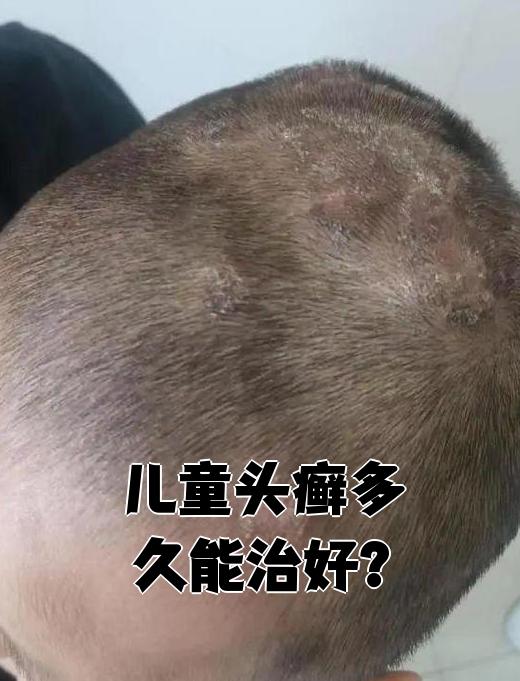 儿童头癣的初期图片(头上一层白皮一抠就变头屑) 儿童头癣的初期图片(头上一层白皮一抠就变头屑)