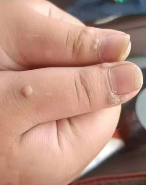 刺猴和疣的区别图片(刺猴和疣的区别图片怎么治疗) 刺猴和疣的区别图片(刺猴和疣的区别图片怎么治疗)