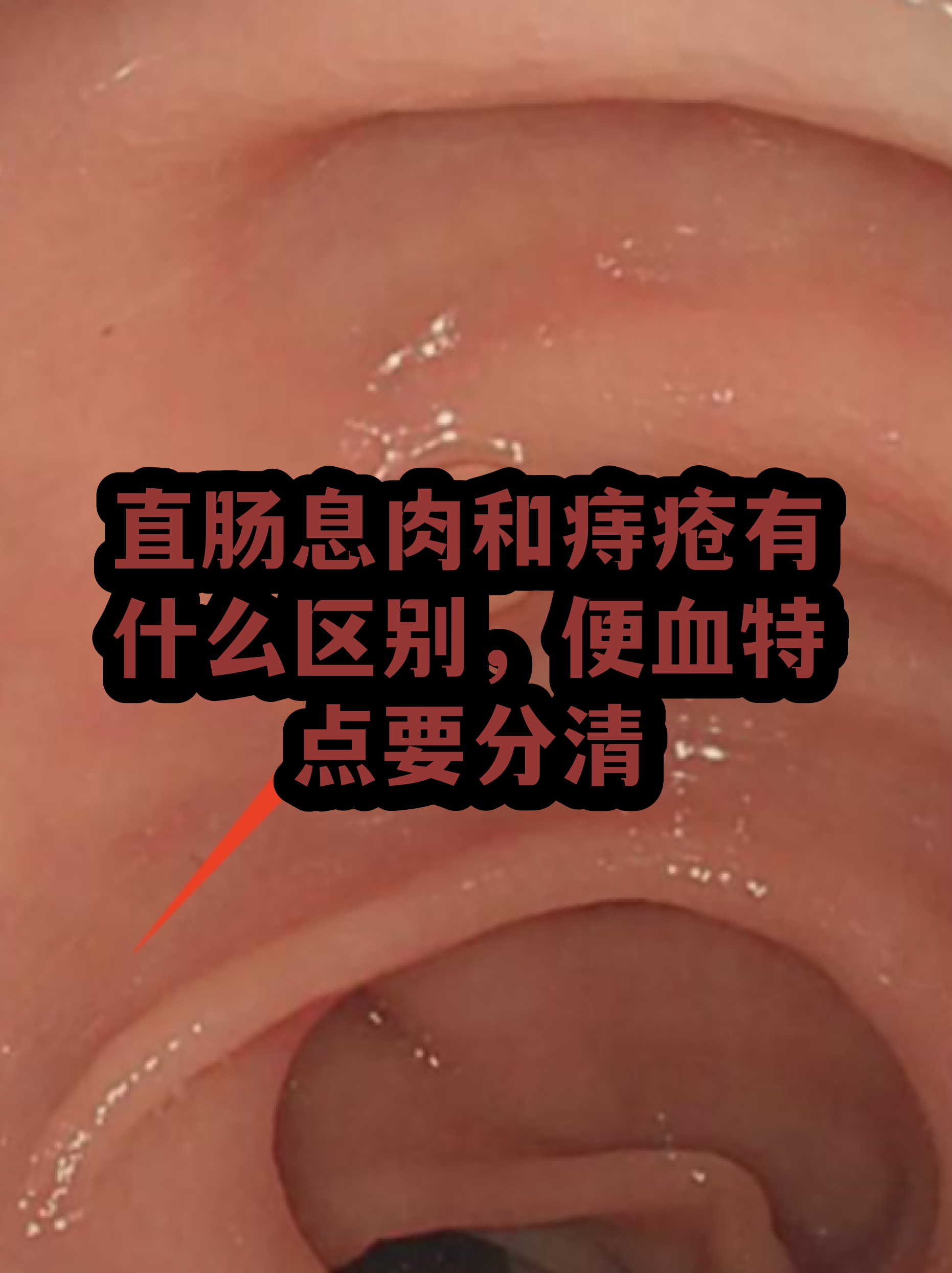 痔疮粘液图片(痔疮有粘液是怎么回事) 痔疮粘液图片(痔疮有粘液是怎么回事)