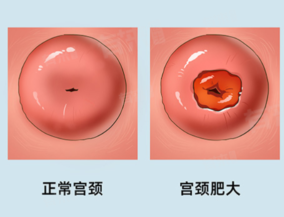 正常宫颈图片(宫颈糜烂图片和正常宫颈图片) 正常宫颈图片(宫颈糜烂图片和正常宫颈图片)