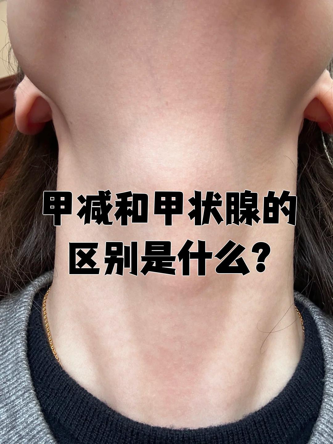 甲减自测脖子(甲减是脖子的哪个位置粗)