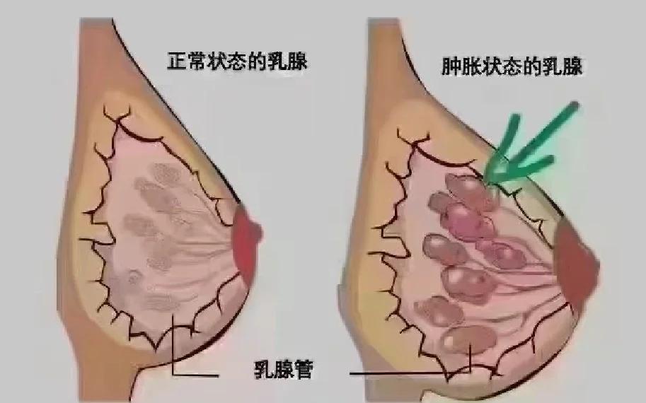 橘皮样乳腺图(橘皮状乳房一定是乳腺癌吗) 橘皮样乳腺图(橘皮状乳房一定是乳腺癌吗)