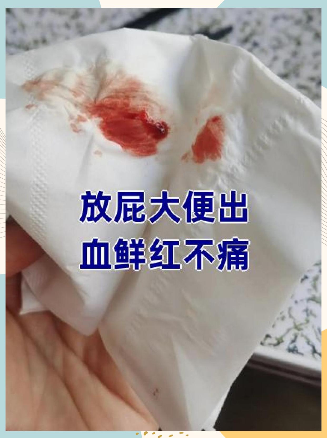 内痔出血图片(内痔大出血有危险吗) 内痔出血图片(内痔大出血有危险吗)