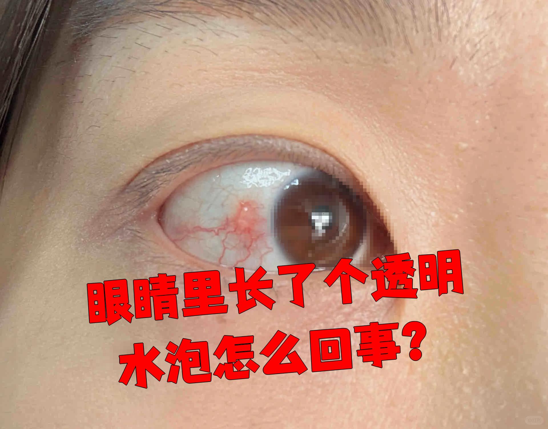 儿童结膜炎症状图片(儿童结膜炎自愈的最佳方法)