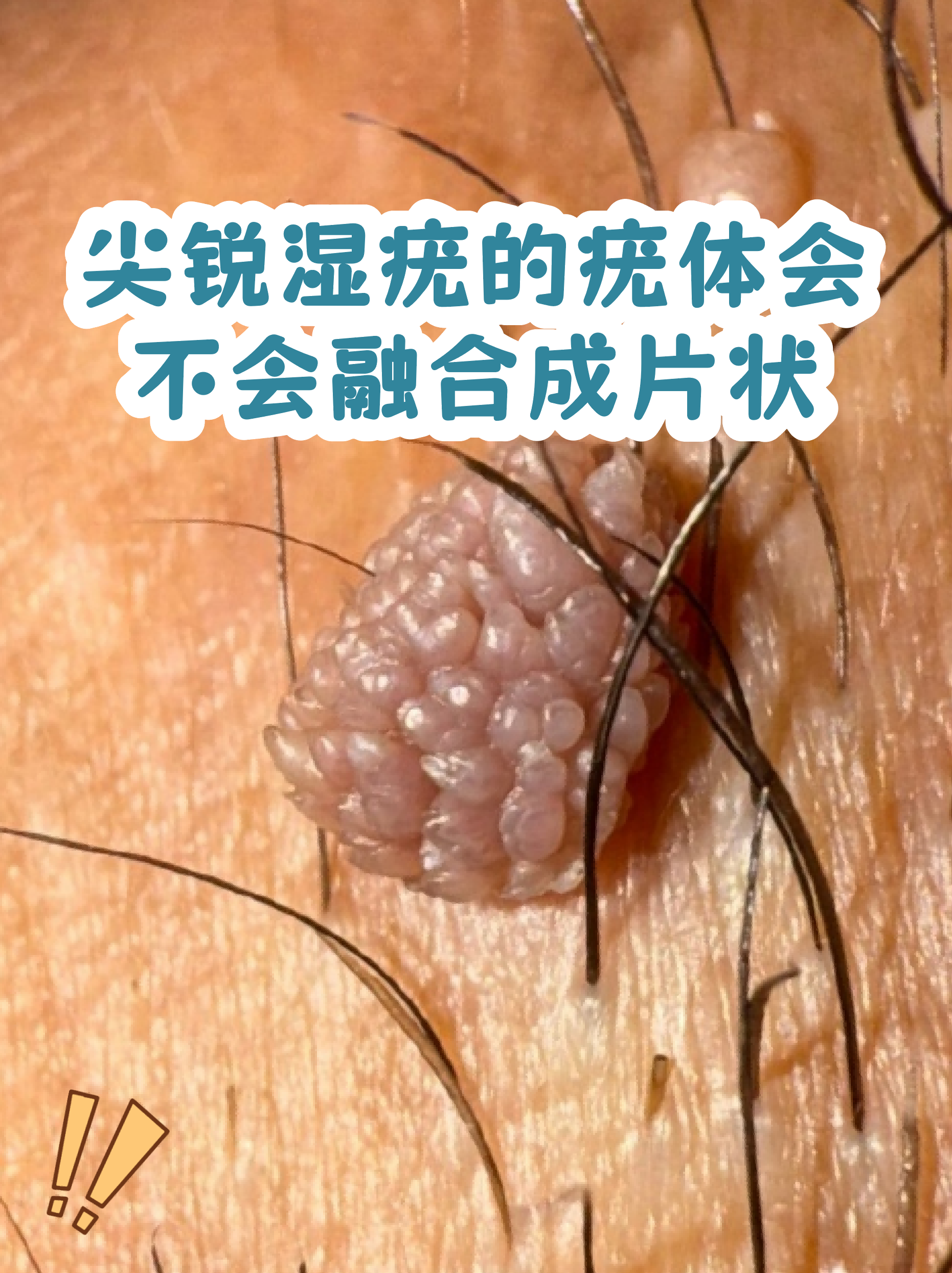 瘊子和疣的区别图片(女性是怎么感染hpv的)