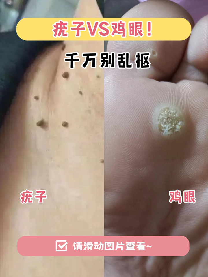 瘊子和疣的区别图片(女性是怎么感染hpv的)