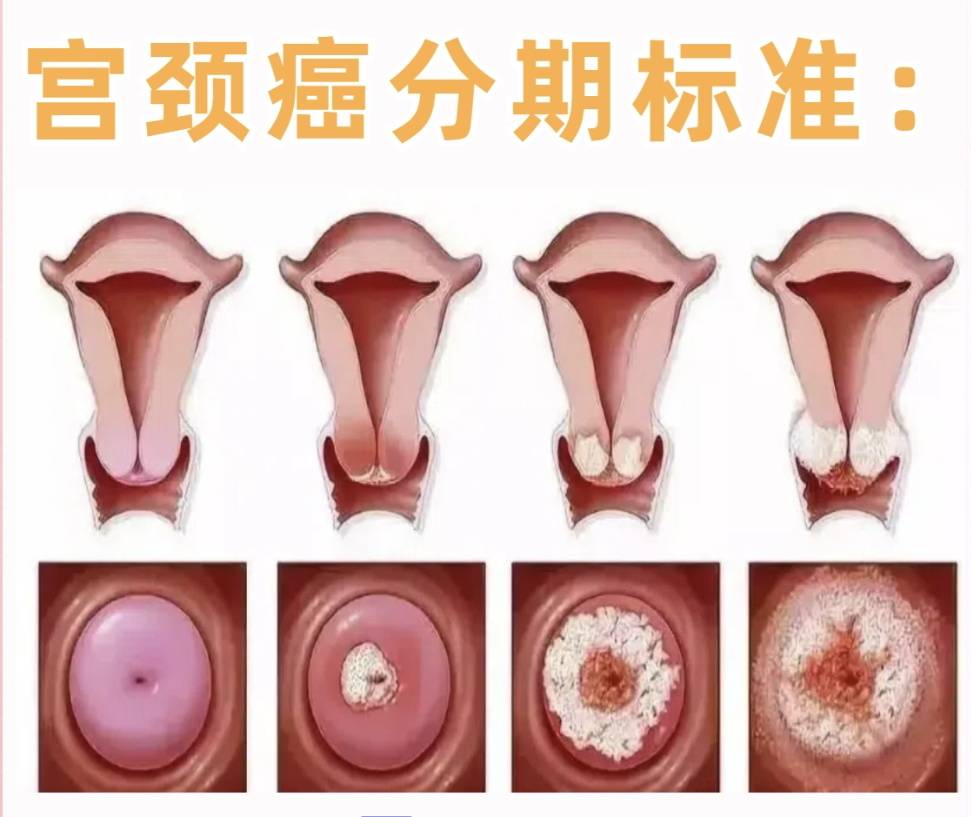初期宫颈癌图片(初期宫颈癌图片宫颈癌病变) 初期宫颈癌图片(初期宫颈癌图片宫颈癌病变)