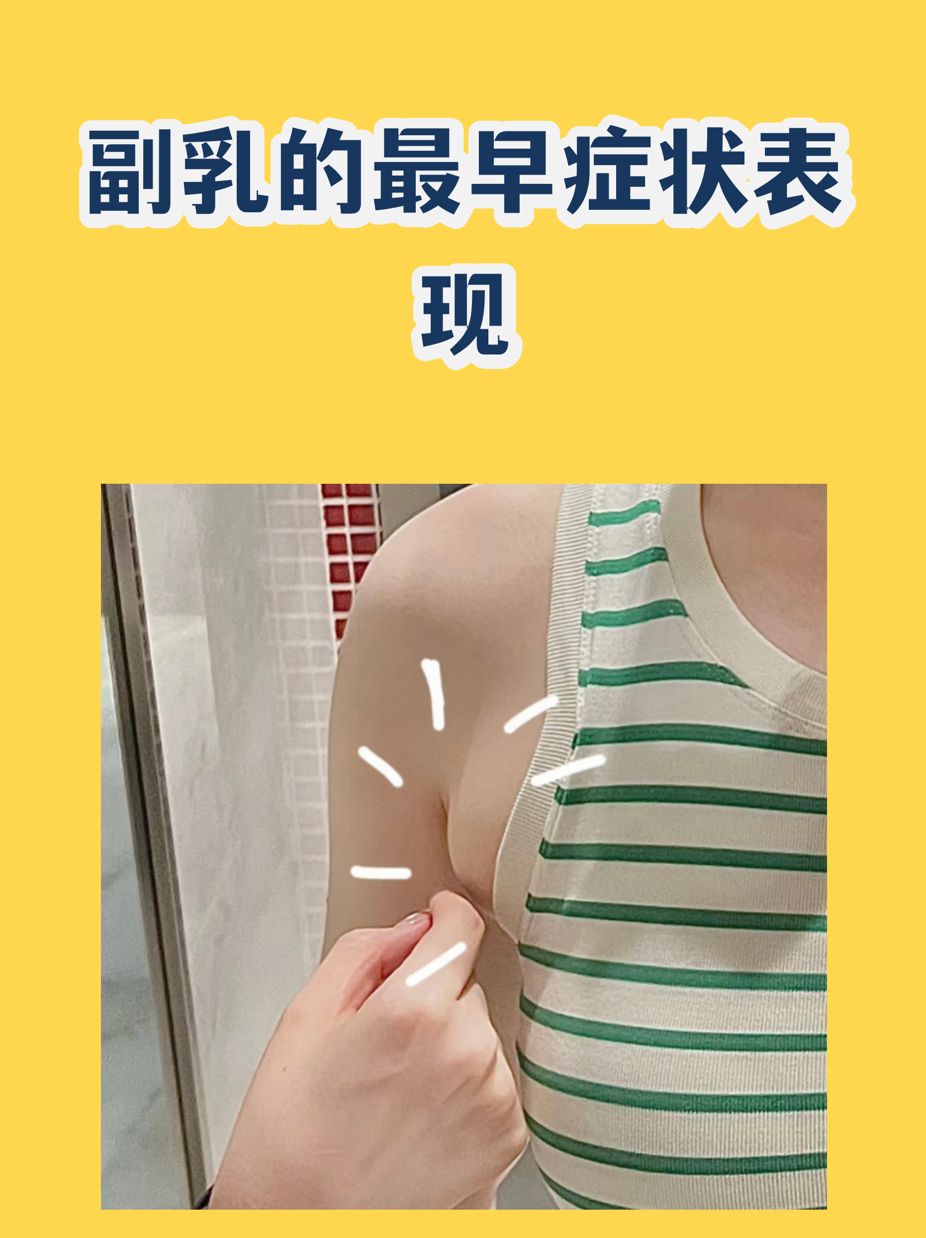 副乳长什么样子图片(副乳长什么样子图片 严重) 副乳长什么样子图片(副乳长什么样子图片 严重)