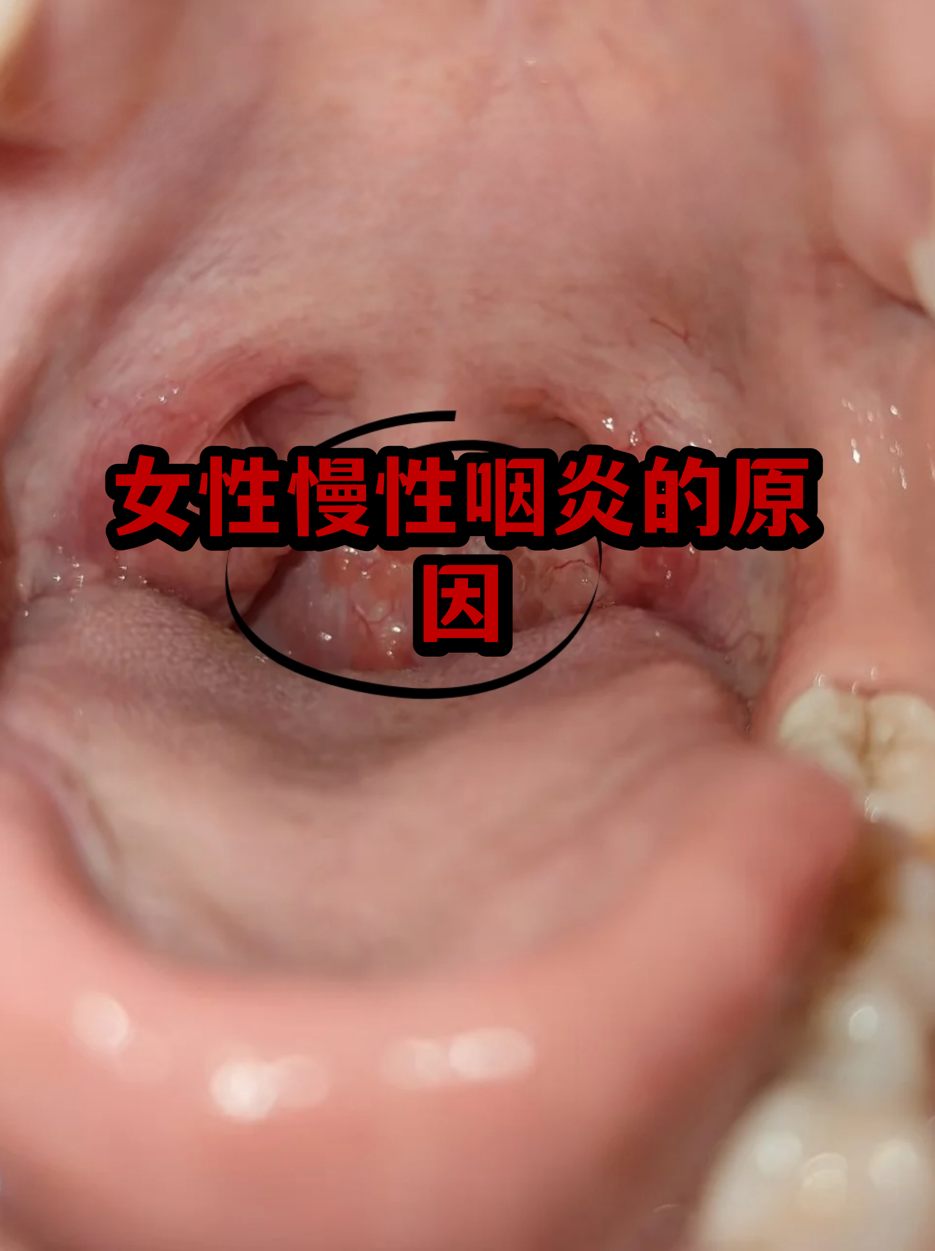嗓子发炎图片(嗓子发炎图片高清图片)