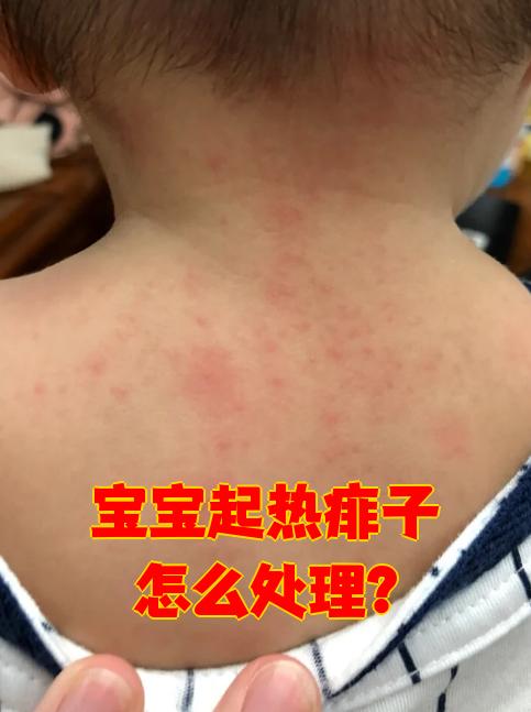 热疙瘩的症状和图片(热疙瘩的症状和图片用什么药)